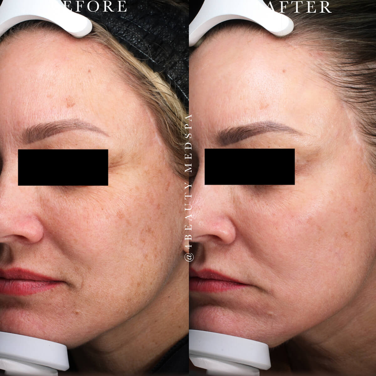 Before and after patient results