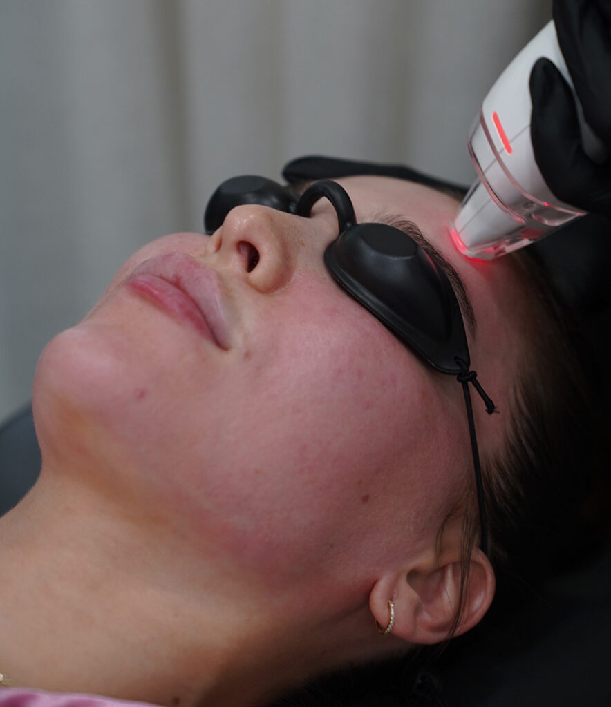 woman getting a lutronic procedure done