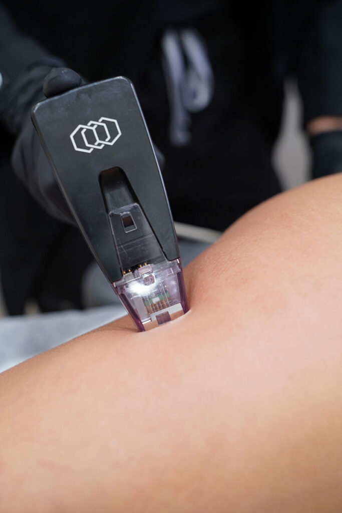 Woman getting Morpheus done